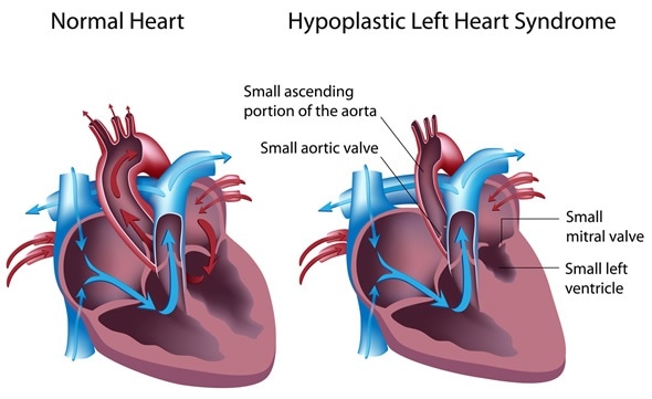 Hypoplastic left heart syndrome - Image Copyright: Alila Medical Media / Shutterstock